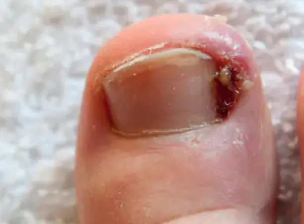 Ingrown toenail treatment